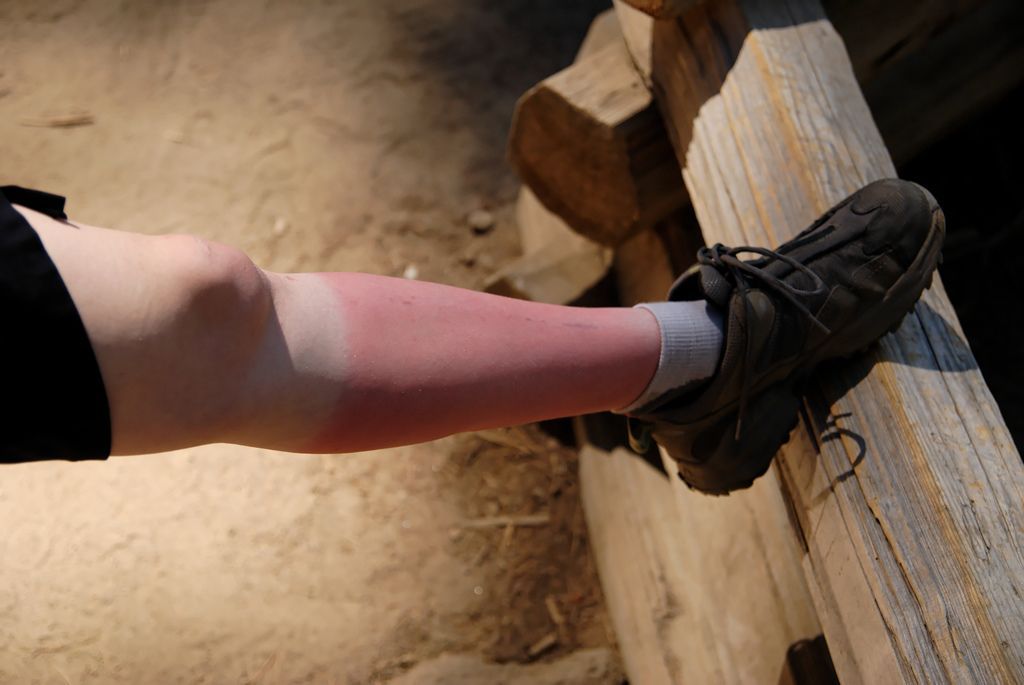 Top 10 best burn remedies in 2026