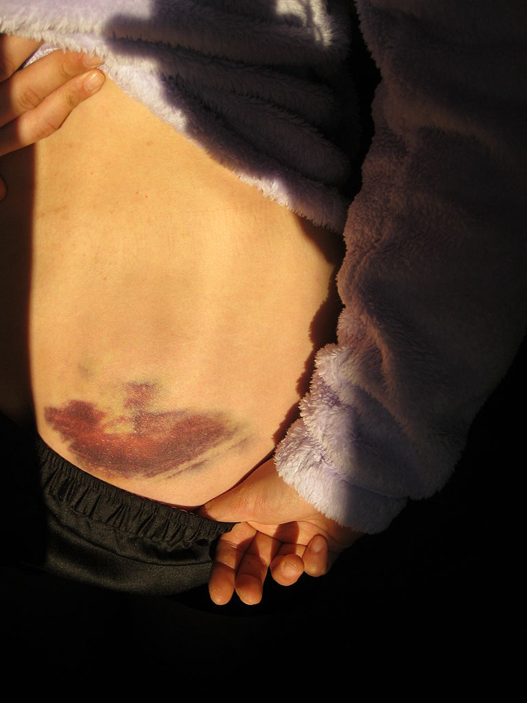 Rating of the best remedies for bruises for 2026