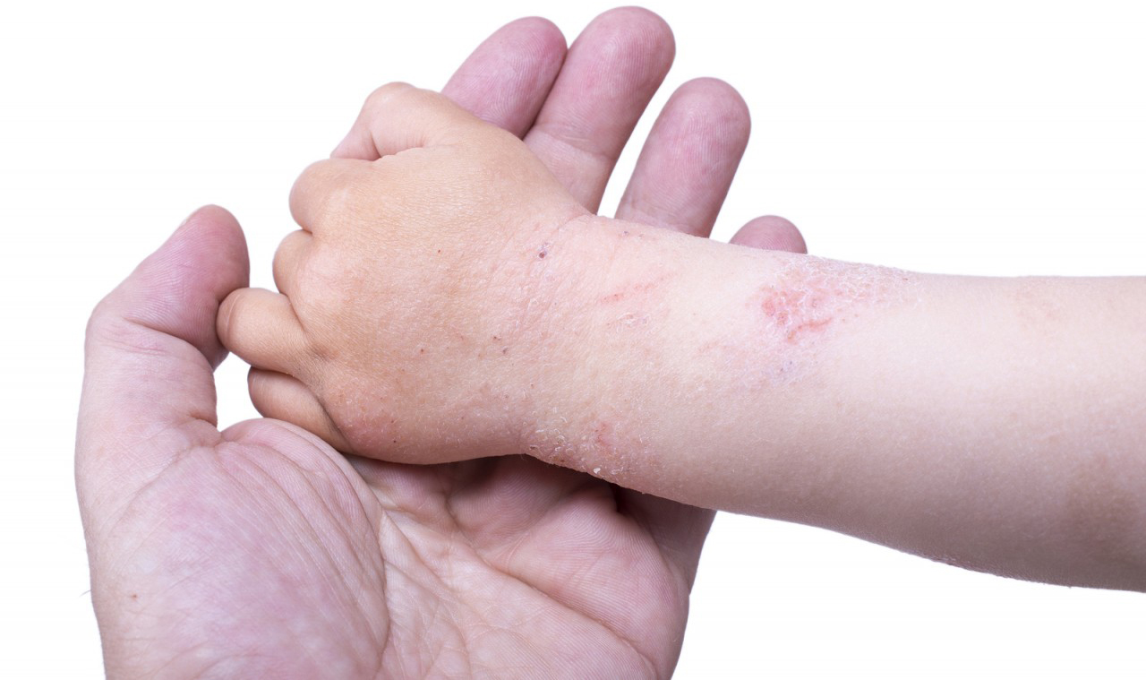 Rating of the best creams for atopic dermatitis for 2026