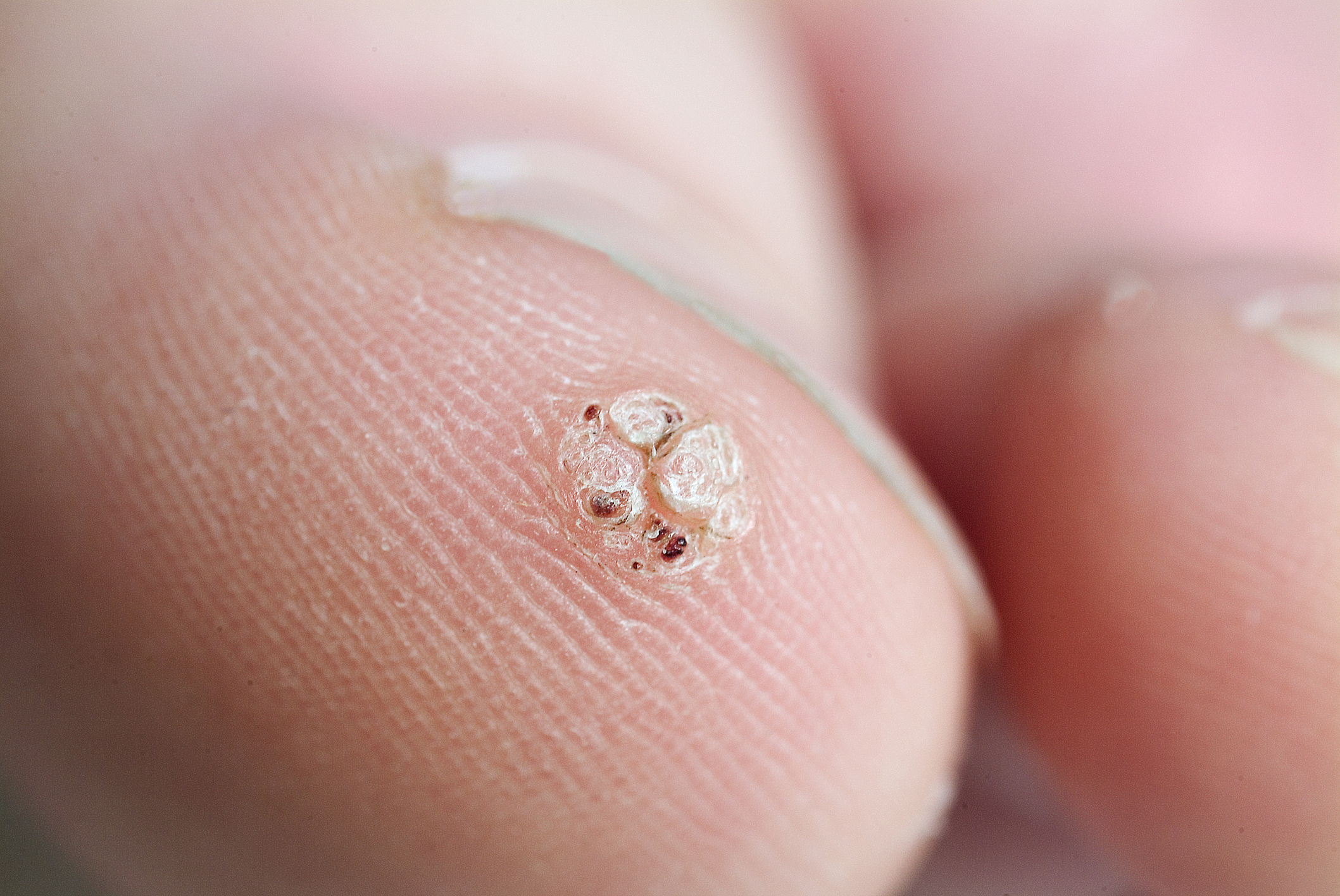 Rating of the best remedies for warts for 2026